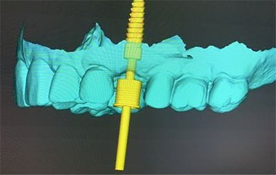 Screenshot of a computer generated CT guided implant model